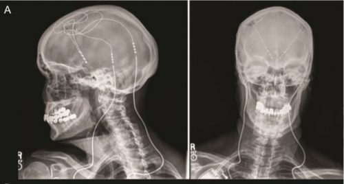 Radiografia de Paciente com um Implante de DBS